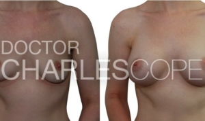 Breast augmentation patient 26yo, before & after surgery 01