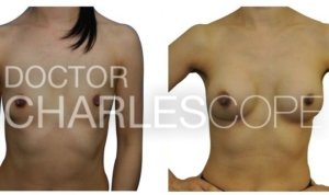 Patient 41yo, breast augmentation before & after, Dr Cope 10-2