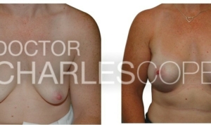 Patient 37yo, breast augmentation gallery, before & after 11
