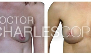 Breast augmentation patient 34yo, Dr Charles Cope