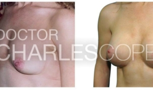 Breast Augmentation - Before & After – 1