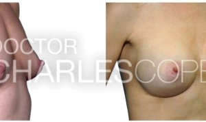 Dr Charles Cope, breast augmentation, 34yo patient, angle view