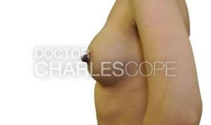 Breast augmentation patient after surgery, side view, photo 12-2