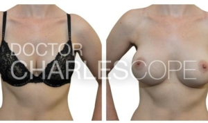 Breast augmentation, before & after 137
