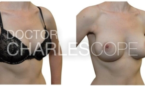Patient before and after breast implant surgery 138