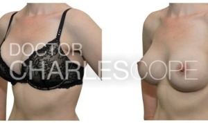 Breast implant surgery before & after 139