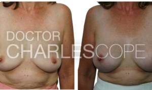 Dr Cope, breast augmentation before & after gallery 14