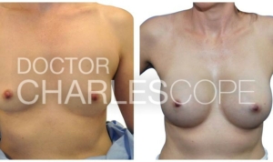Breast augmentation before & after 145
