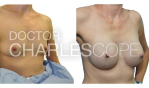 Breast augmentation photo 147, Dr Charles Cope