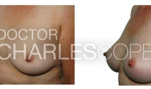 52yo patient, breast augmentation before & after, photo 15