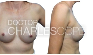 40yo patient, breast augmentation gallery, Dr Cope 152