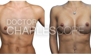 Patient before & after breast implants procedure, 26yo patient, photo 153