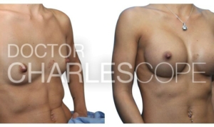 Breast augmentation gallery 154, before & afters
