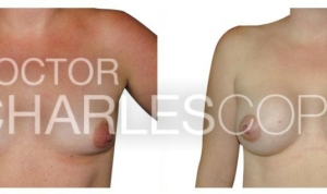 Breast augmentation before & after, 40yo patient, Dr Charles Cope 16