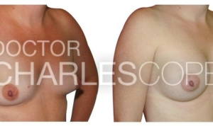 Patient 40yo before and after breast augmentation surgery with Dr Cope, photo 17