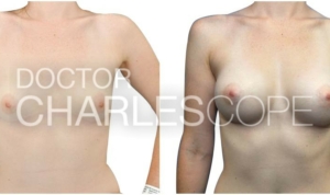 Patient 24yo, breast implants, before & after 171