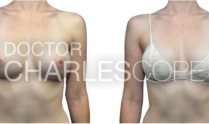 Breast augmentation gallery 172, Dr Charles Cope