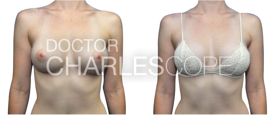 Breast Augmentation Sydney & Gosford – 7