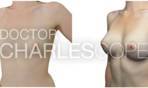 Breast implants, photo gallery 173, before & after