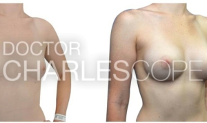 Breast augmentation patient, before & after 175