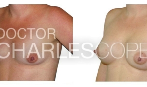 Breast augmentation, 40yo patient, image 18, Dr Charles Cope