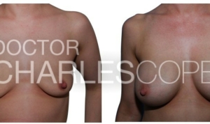 Patient 34yo, breast augmentation gallery 19, Dr Cope