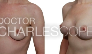 Breast augmentation 02, before & after gallery, Dr Charles Cope