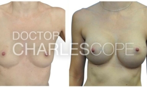 Dr Cope, breast augmentation patient 40yo, before & after gallery, front view