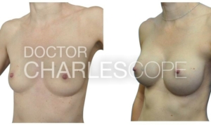 Breast augmentation surgery, before & after gallery 24-2, Dr Cope