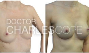 Breast augmentation surgery, photo gallery 25-2, before & after