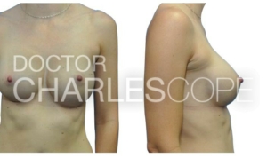 Breast augmentation before & after 26, Dr Charles Cope