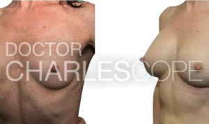 40yo patient before and after breast augmentation surgery, Dr Cope 03-2