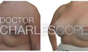 Dr Charles Cope, breast augmentation gallery 47