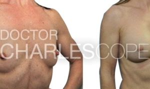 Breast augmentation procedure, before and after photo 04-2, 40yo patient