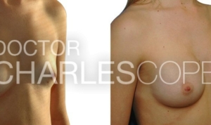 Breast augmentation 05, before & after, Dr Cope, 27yo patient