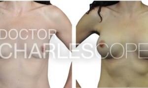 Patient before & after breast augmentation 06-2