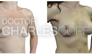 34yo patient before and after breast augmentation, Dr Charles Cope