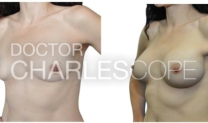 Breast augmentation with implants, before & after, 34yo patient 08-2