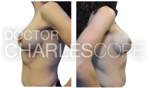 Breast augmentation surgery, Dr Charles Cope, 09-2