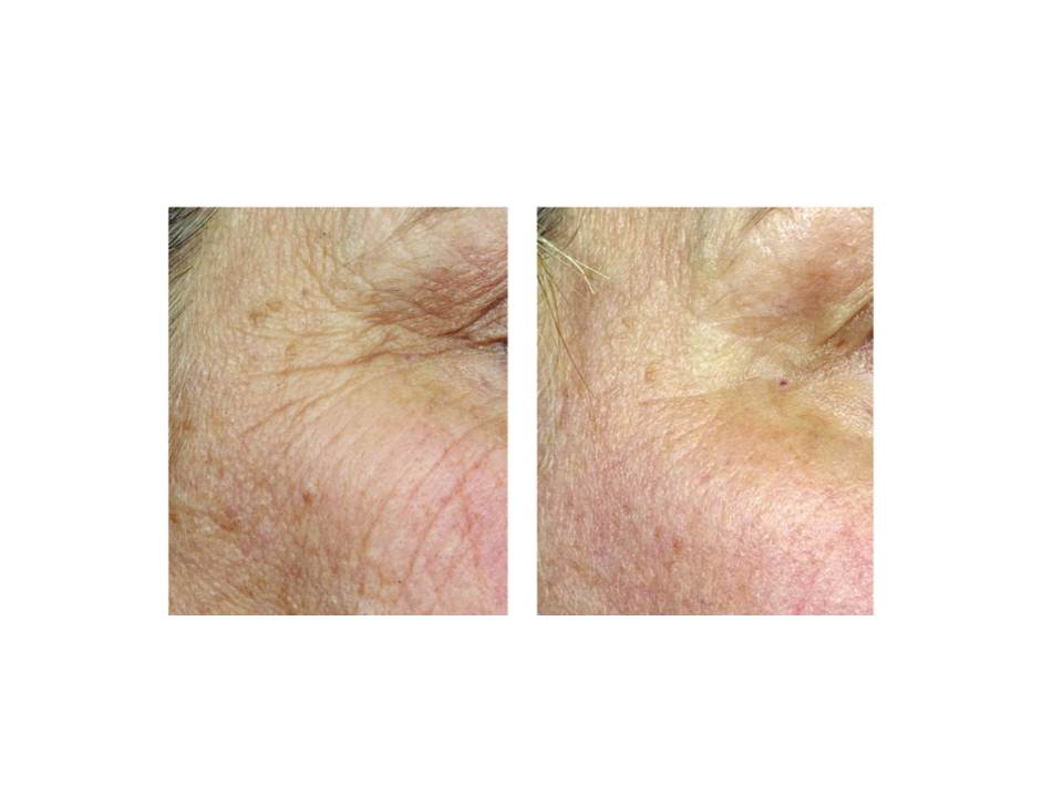 Fraxel laser skin rejuvenation, before and after photo 02