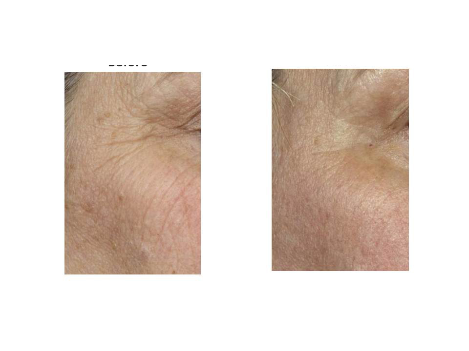 Fraxel laser photo 04, before & after treatment