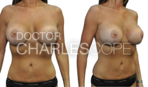Breast & abdominal surgery – 3