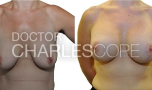 30yo patient before and after breast augmentation and lift surgery with Dr Cope 115-2