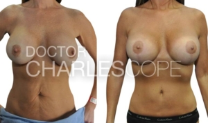 Breast & abdominal surgery – 8