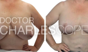 Breast reduction gallery 129, Dr Cope Sydney & Gosford