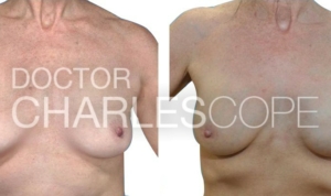 Implant Breast Reconstruction – 2