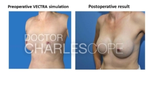 Vectra Breast Augmentation Simulations – 5