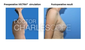 Vectra Breast Augmentation Simulations – 3
