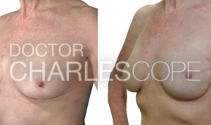 Implant Breast Reconstruction – 3