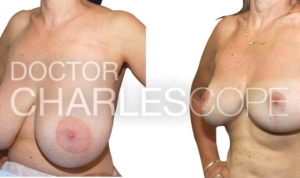 Patient before and after breast reduction (EE to D cup), photo 160